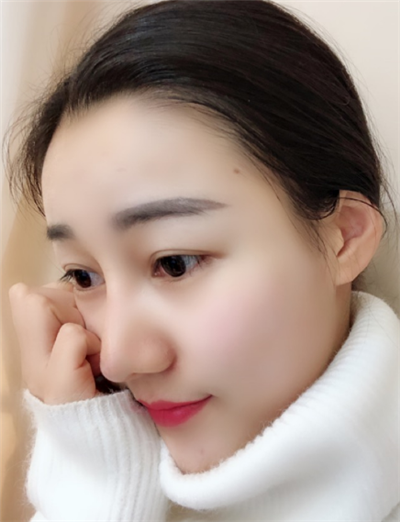 長春中妍醫(yī)療美容醫(yī)院王軍隆鼻案例效果分享