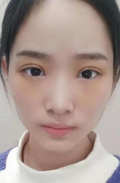 長(zhǎng)沙星雅醫(yī)療美容醫(yī)院萬(wàn)友望雙眼皮案例效果分享