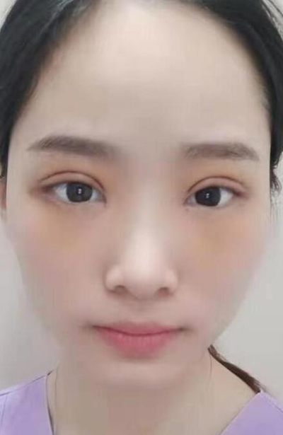  長沙星雅醫(yī)療美容醫(yī)院做雙眼皮手術后的大眼