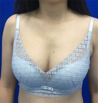 煙臺壹美整形美容醫(yī)院做隆胸手術后半個月的情形
