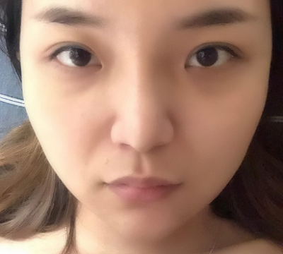 寧波尚美整形美容醫(yī)院做隆鼻手術后的一周