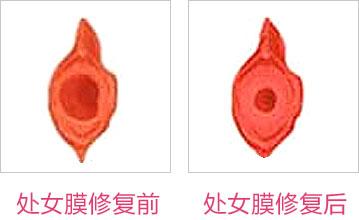 成都東方整形處女膜修復(fù)怎么樣？處女膜修復(fù)術(shù)后如何護(hù)理？