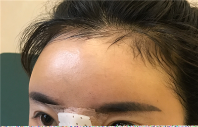 煙臺(tái)壹美整形美容醫(yī)院楊彪炳隆鼻案例效果分享