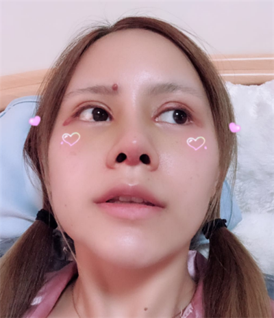 深圳弘美醫(yī)療美容門診部做眼綜合手術(shù)后的恢復(fù)情況