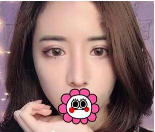 有“鼻王”之稱的楊群申做鼻子到底怎么樣？隆鼻前后圖片