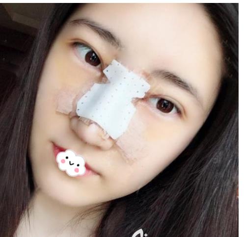 長(zhǎng)春亞韓整形假體隆鼻案例術(shù)后兩天