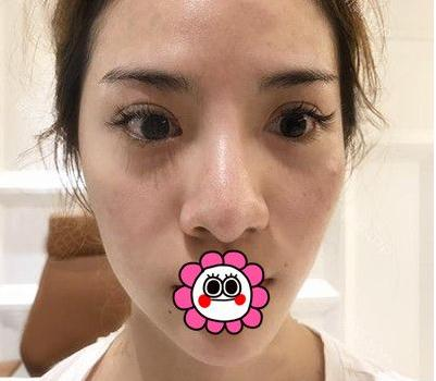 有“鼻王”之稱的楊群申做鼻子到底怎么樣？隆鼻前后圖片
