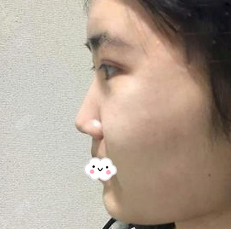 長(zhǎng)春亞韓整形假體隆鼻案例術(shù)前側(cè)面