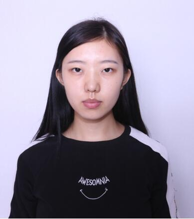 做雙眼皮案例，第四軍醫(yī)大學(xué)唐都醫(yī)院李望舟雙眼皮案例圖片