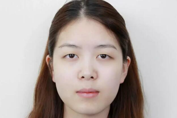 做雙眼皮案例，鄭州壹加壹王洛生全切雙眼皮案例圖片