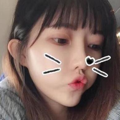 做雙眼皮案例，第四軍醫(yī)大學(xué)唐都醫(yī)院李望舟雙眼皮案例圖片