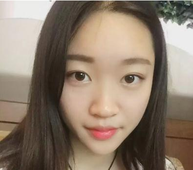 宜昌奧萊楊群申超體隆鼻案例分享，有圖