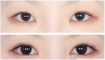 桂林柏琳整形開內(nèi)眼角多少錢？開內(nèi)眼角注意哪些?