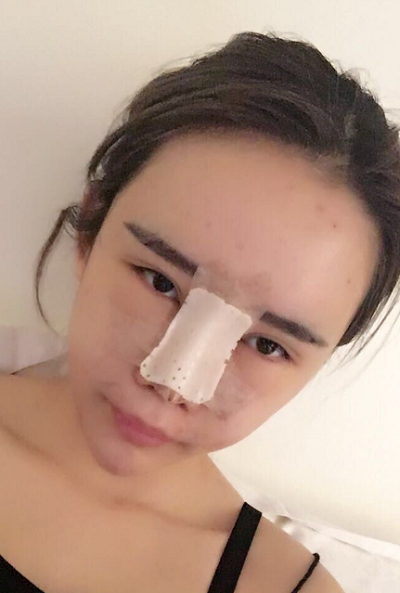 上海伊美爾港華醫(yī)療美容醫(yī)院做自體肋軟骨隆鼻手術(shù)剛剛結(jié)束