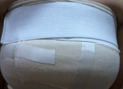 上海美萊醫(yī)療美容門診部做假體隆胸手術后包裹狀態(tài)