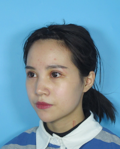 成都美立方（原華博）醫(yī)療美容醫(yī)院做眼部修復手術拆線后