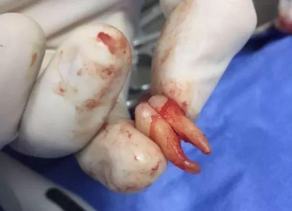 福州登特口腔拔智齒有哪些利弊？拔智齒有哪些情況？