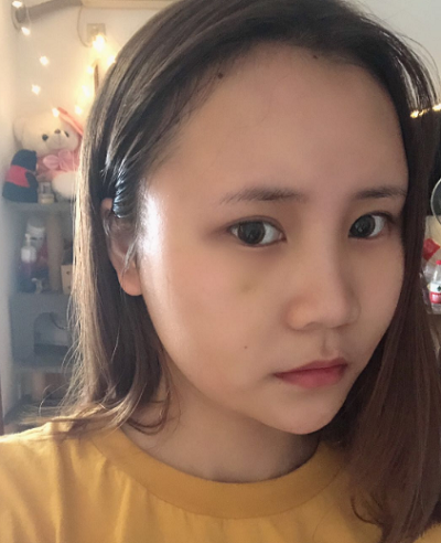 上海美萊醫(yī)療美容門診部做面部填充術(shù)后的日常恢復(fù)
