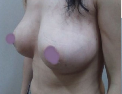 上海美萊醫(yī)療美容門診部做假體隆胸手術后的胸部開始挺翹