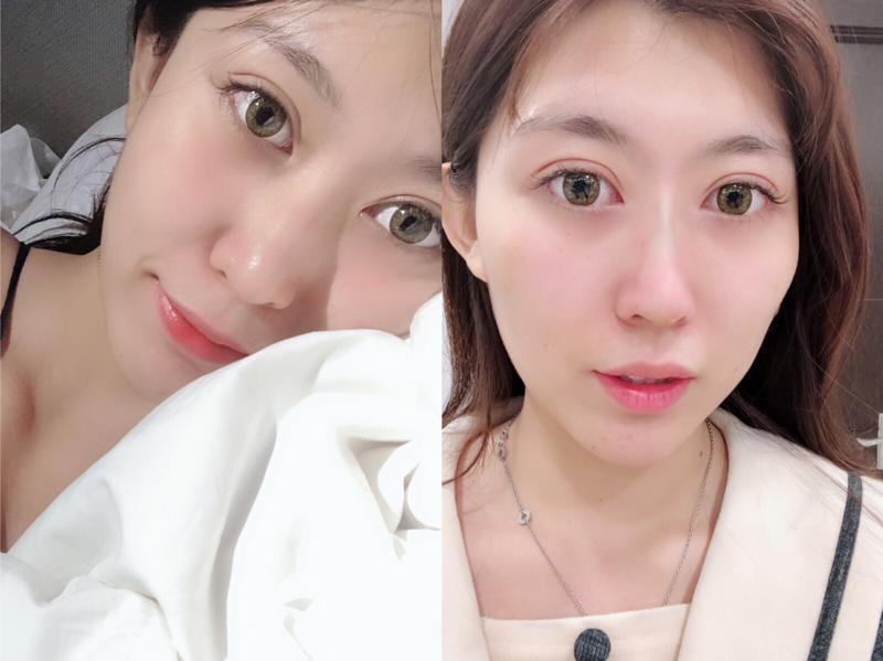 埋線(xiàn)手術(shù)鼻子的效果能保持多久？埋線(xiàn)手術(shù)鼻子術(shù)后的注意事項(xiàng)？