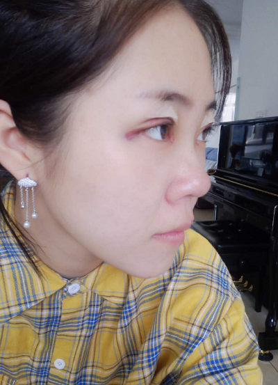 北京東方瑞麗醫(yī)療美容門診部做雙眼皮剛剛做完手術