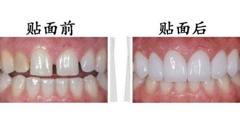 東莞拜博口腔瓷貼面有什么優(yōu)勢？瓷貼面有副作用嗎？