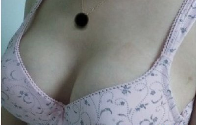 上海美萊醫(yī)療美容門診部做假體隆胸術后無鋼圈內衣