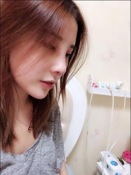 上海藝星醫(yī)療美容醫(yī)院做鼻綜合術(shù)后的日?；謴?fù)情況