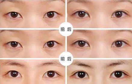 貴州旭美人整形埋線雙眼皮優(yōu)點(diǎn)有哪些如何選擇？