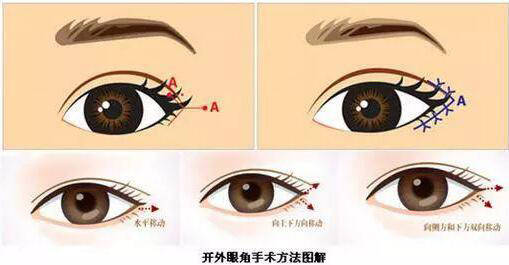 桂林嘉美醫(yī)療開(kāi)外眼角是什么？開(kāi)外眼角適用人群？