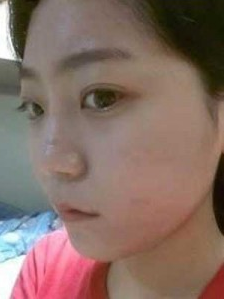 上海時(shí)光整形外科醫(yī)院做耳軟骨隆鼻手術(shù)前