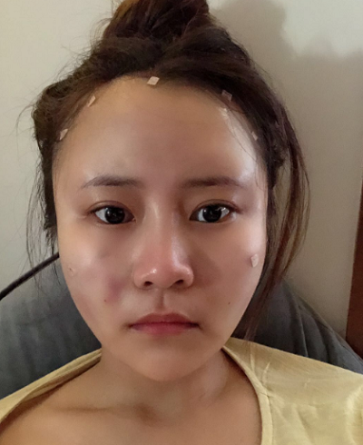 上海美萊醫(yī)療美容門診部做面部填充手術(shù)前的狀態(tài)