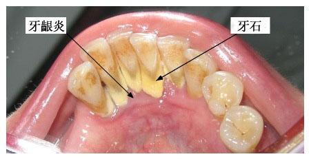  廣州柏德口腔牙齦炎怎樣治療吃什么消炎藥？