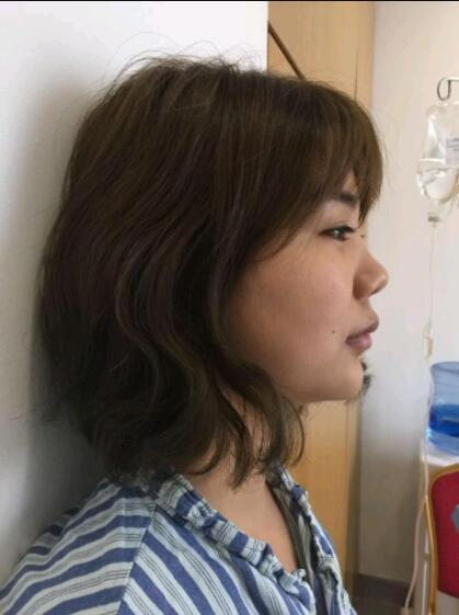 上海美萊醫(yī)療美容門(mén)診部盧建隆鼻案例效果分享