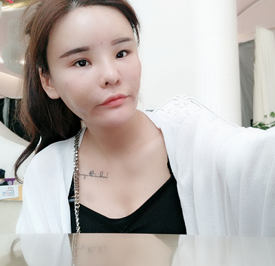上海美萊醫(yī)療美容門診部做面部填充手術(shù)后的日?；謴?fù)